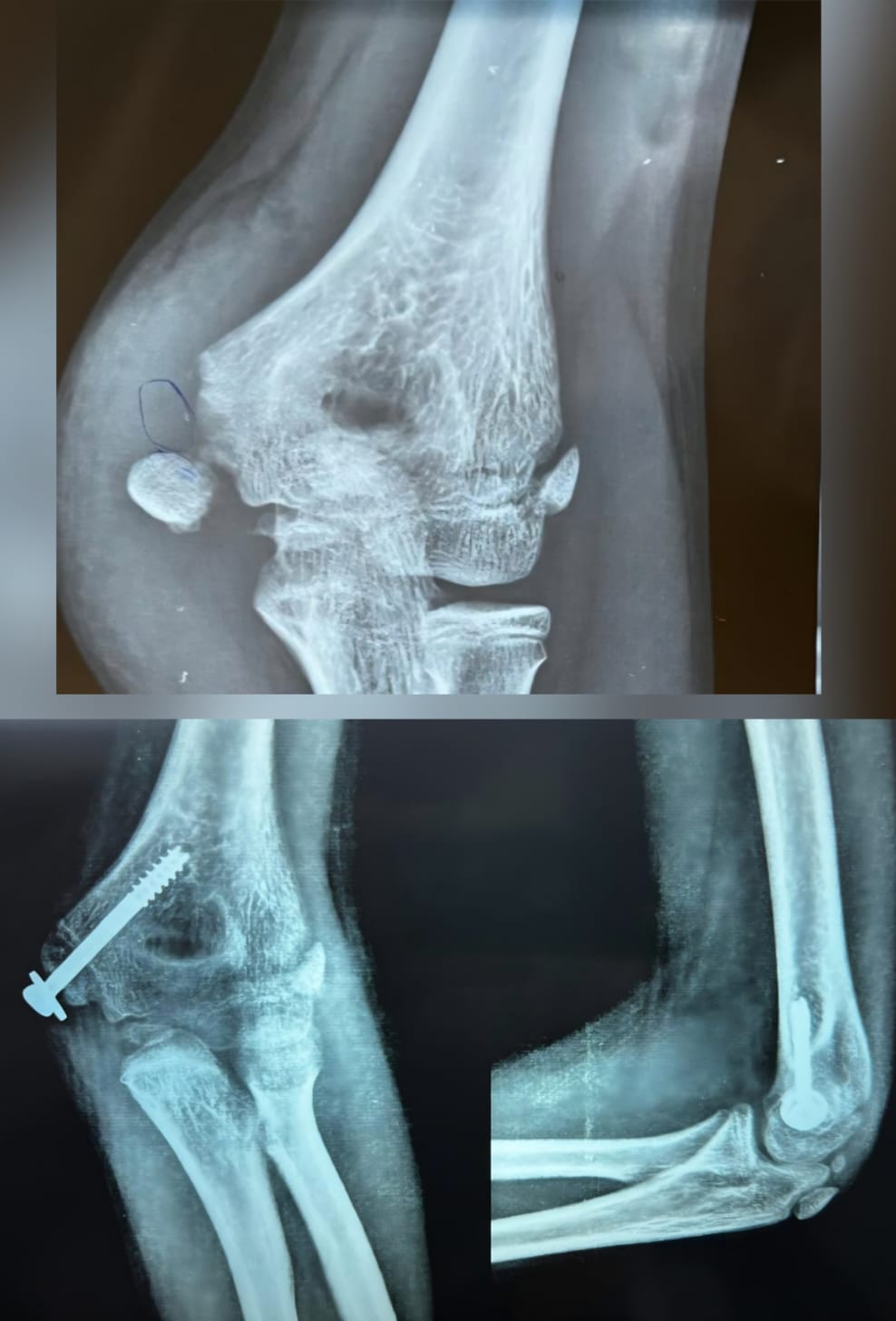 Paediatric elbow fracture