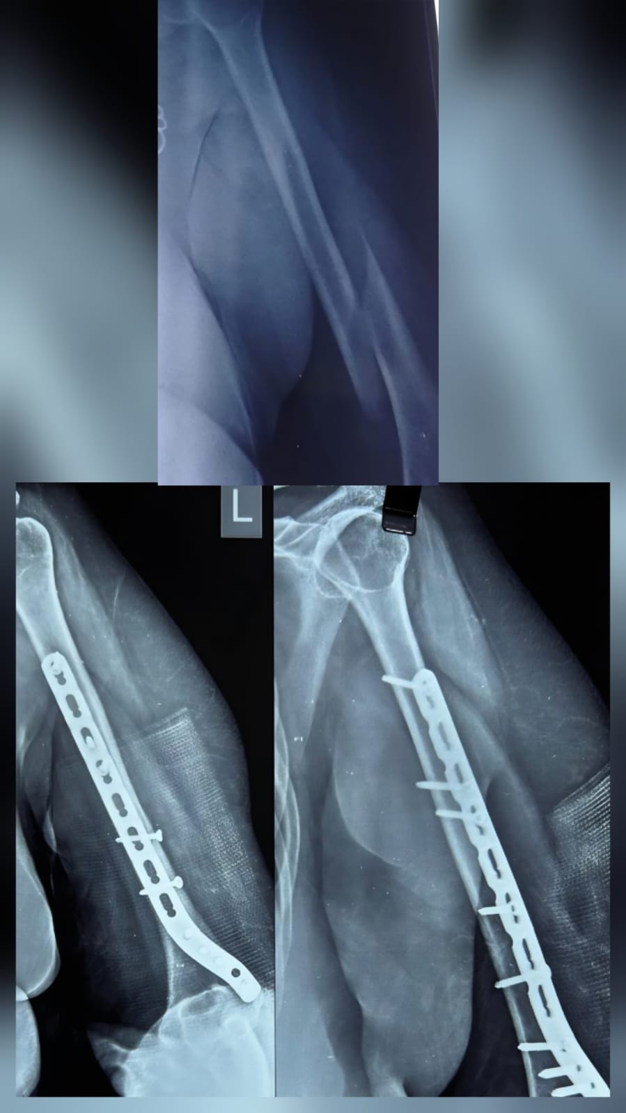 Humerus fracture - ORIF Plating