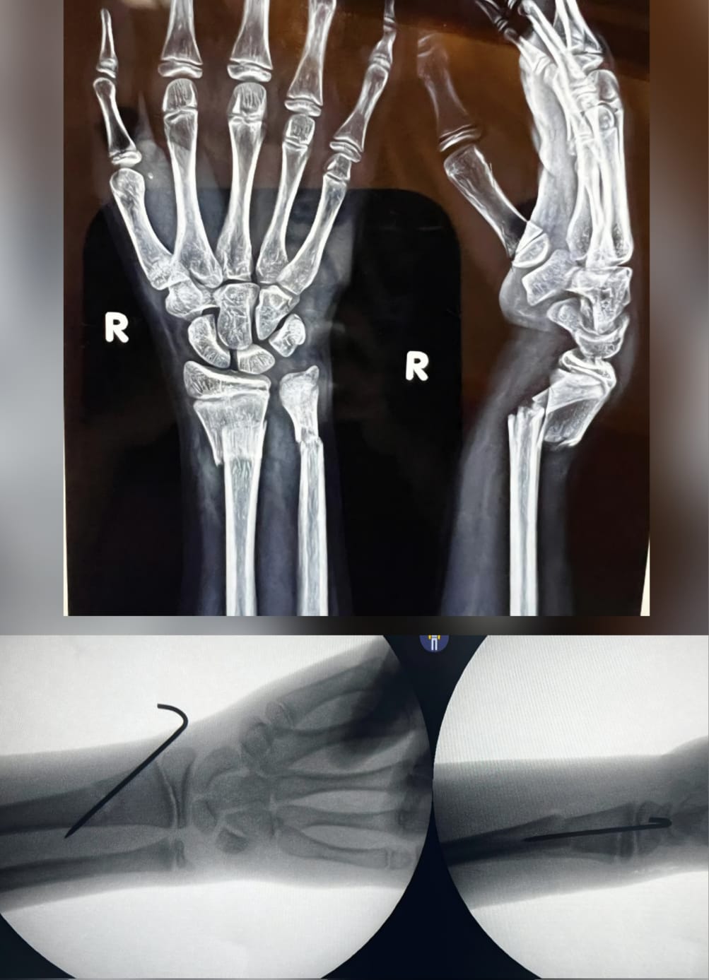 Pediatric wrist fracture